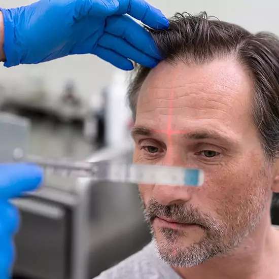 Saç ekimi ağrılı mı