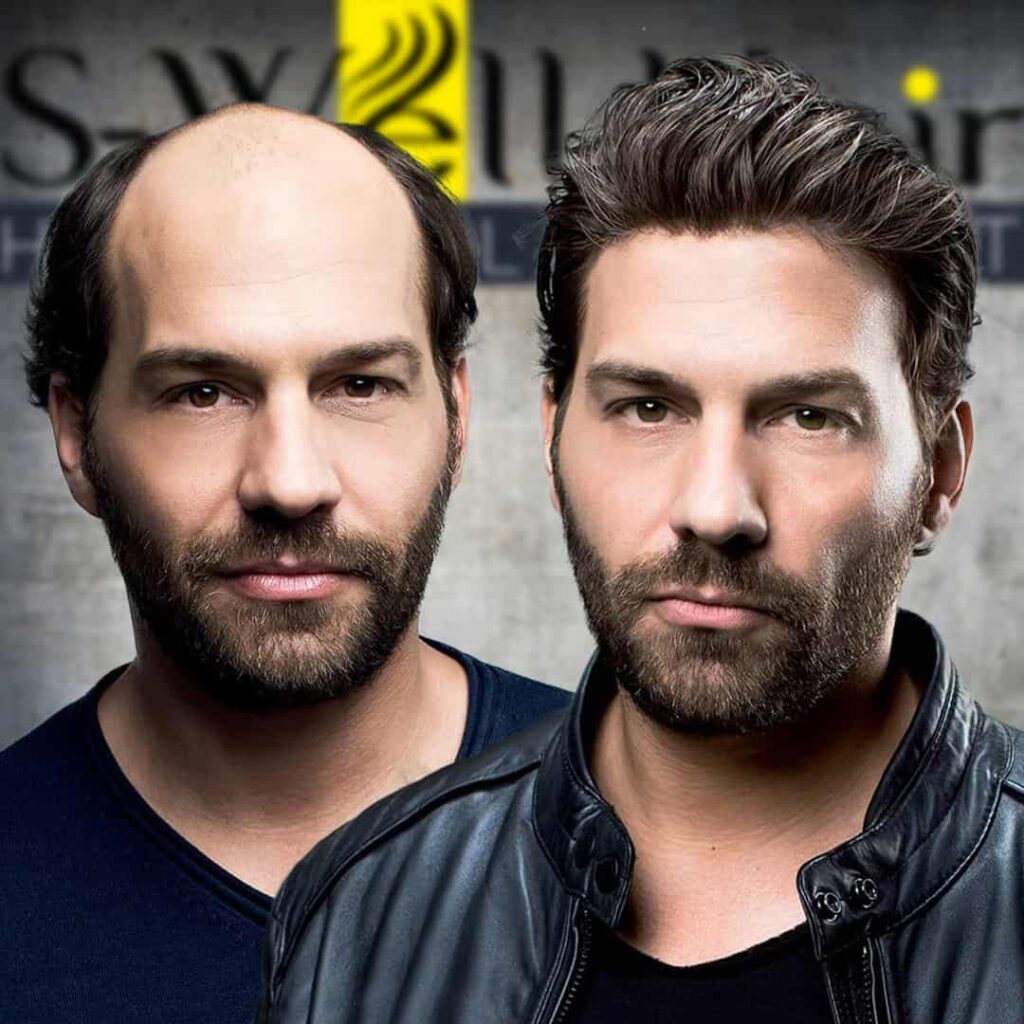 Protez saç ne kadar dayanır